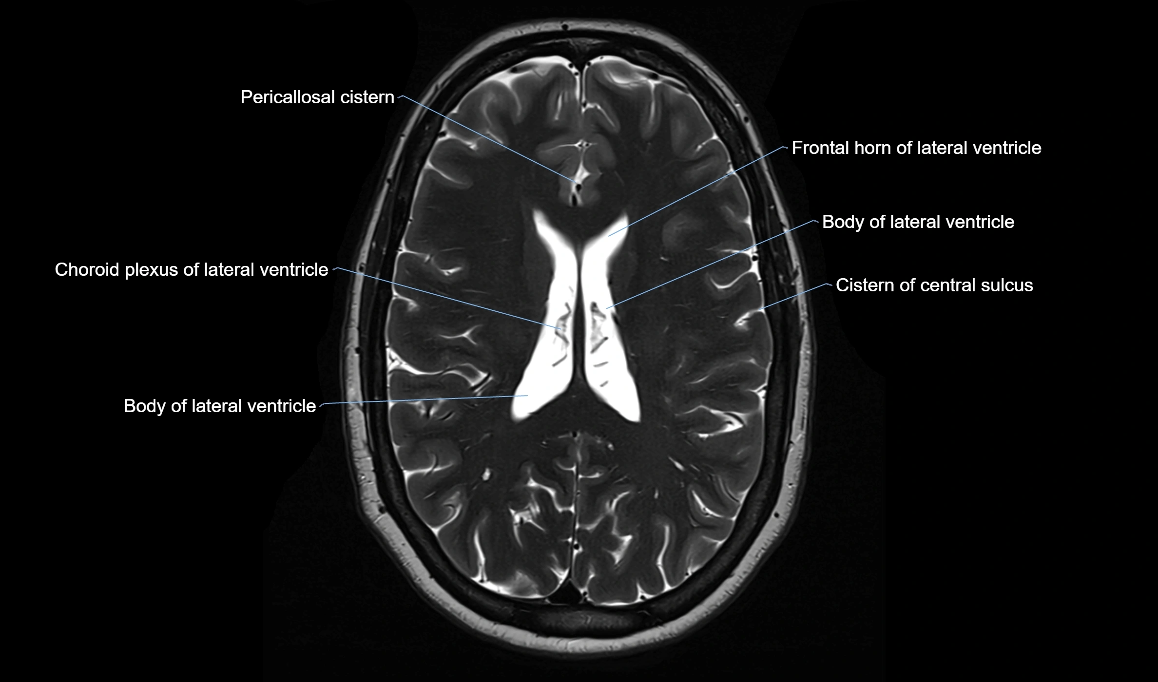 Brain cisterns  and ventricles  axial anatomy 3T MRI image-img-00001-00035.webp